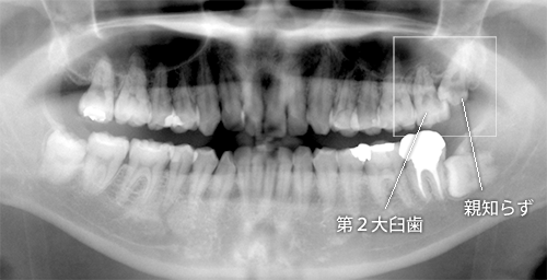 親知らずの害1