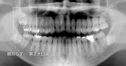 親知らずの害3