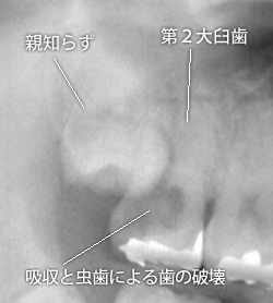 親知らずの害4