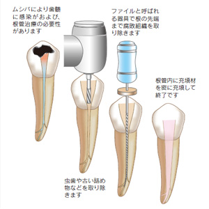 根管治療