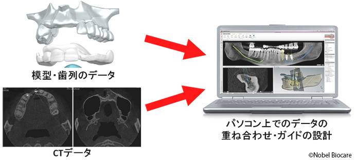 ガイド手術