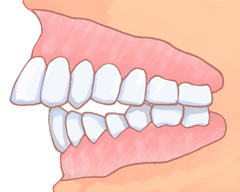 不正咬合