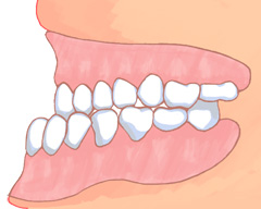 不正咬合