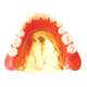 PG床義歯