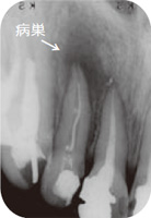 根管治療